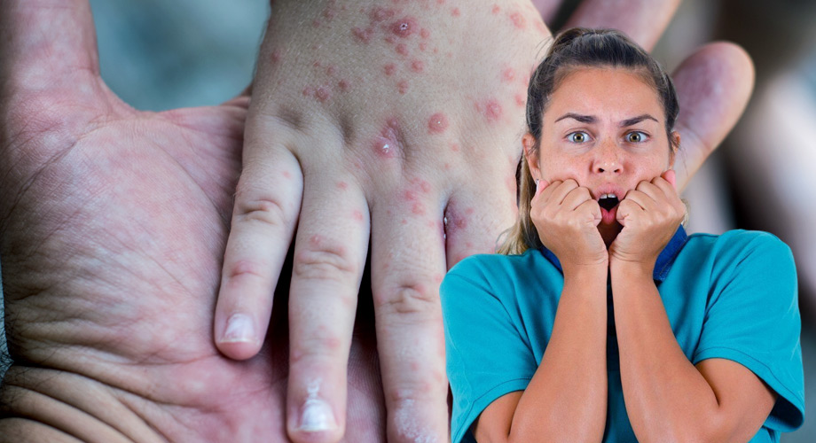 La mala salud metabólica fomenta brotes como el Coxsackie