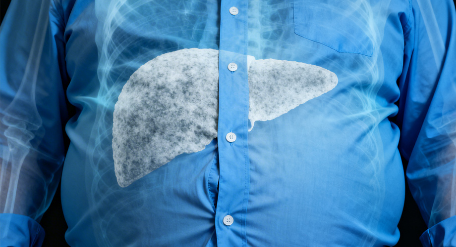 Hígado graso: amenaza silenciosa